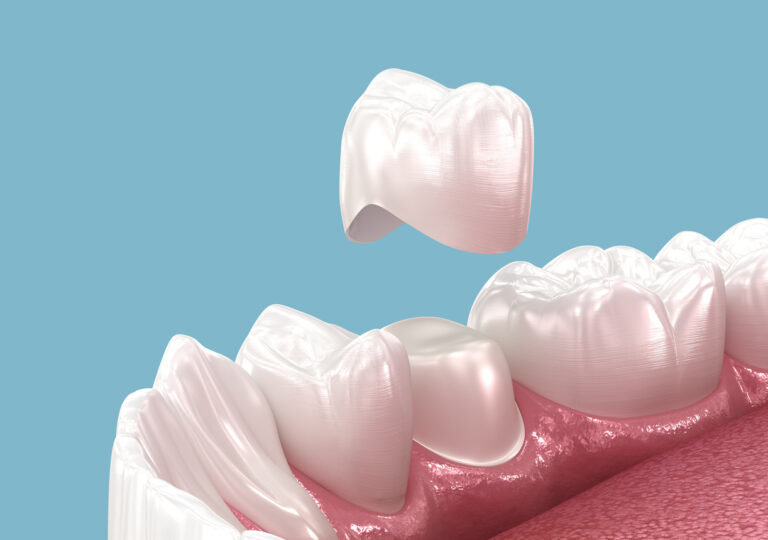 The image illustrates a dental procedure where a crown is being placed over a tooth in the lower jaw. The gums and adjacent healthy teeth are visible, highlighting the crown's placement to restore the tooth's function and appearance.