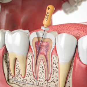 Root Canal FAQ at C W Family Dentistry in West Covina, CA
